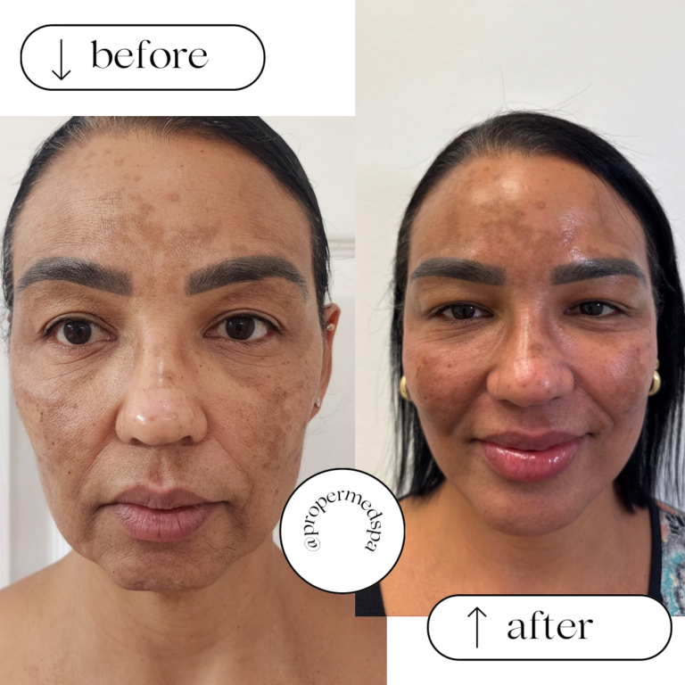 Full Facial Rejuvenation Patient at Proper Medspa In Pembrkoe Pine, FL