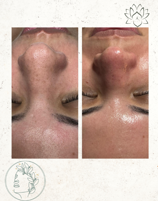 Skin Tag & DPN Removal in Pembroke Pines